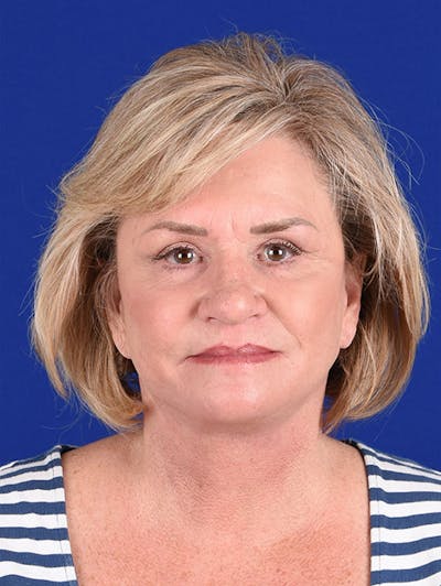 Facelift Before & After Gallery - Patient 10670015 - Image 2