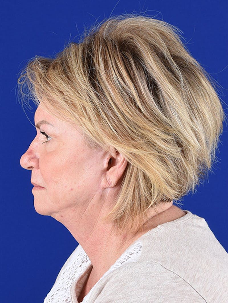 Facelift Before & After Gallery - Patient 10670015 - Image 5
