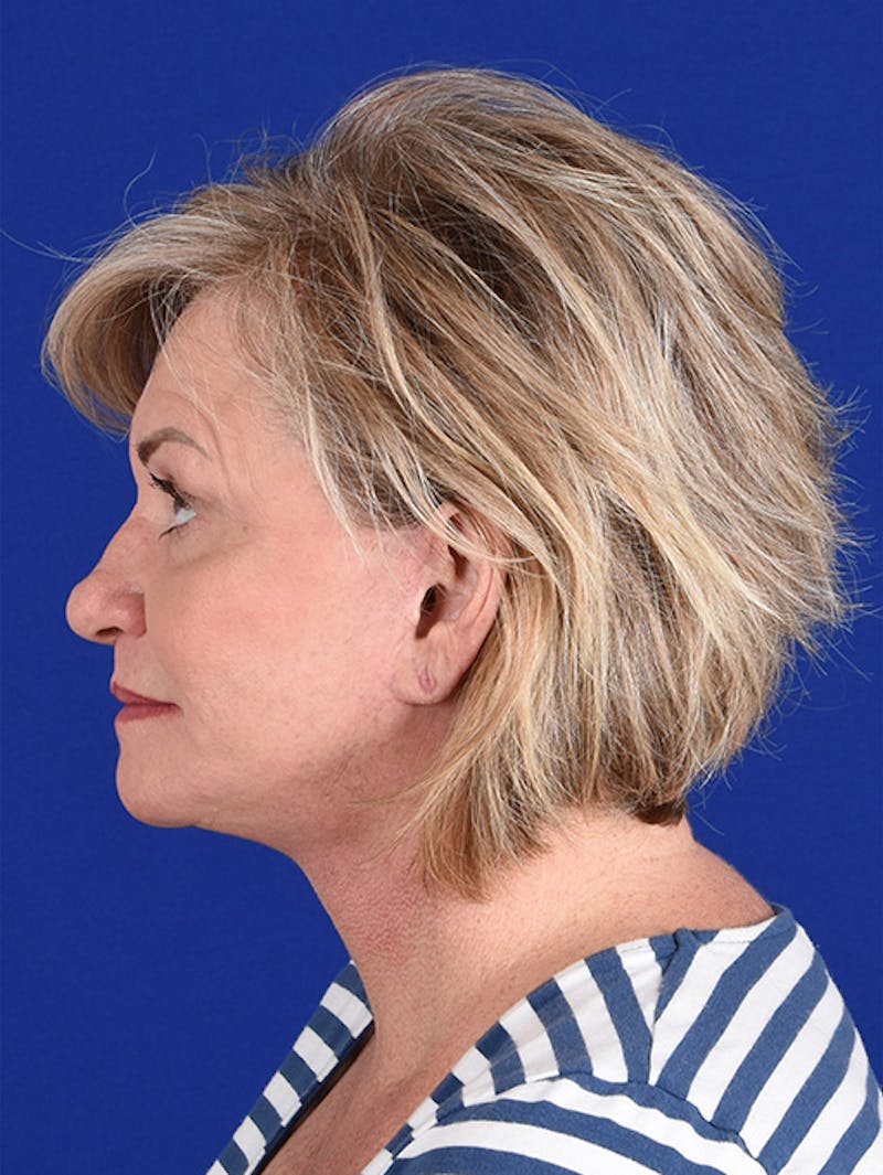 Facelift Before & After Gallery - Patient 10670015 - Image 6