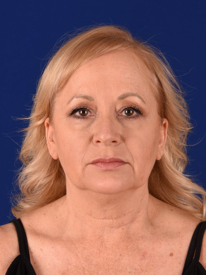 Facelift Before & After Gallery - Patient 10670025 - Image 1