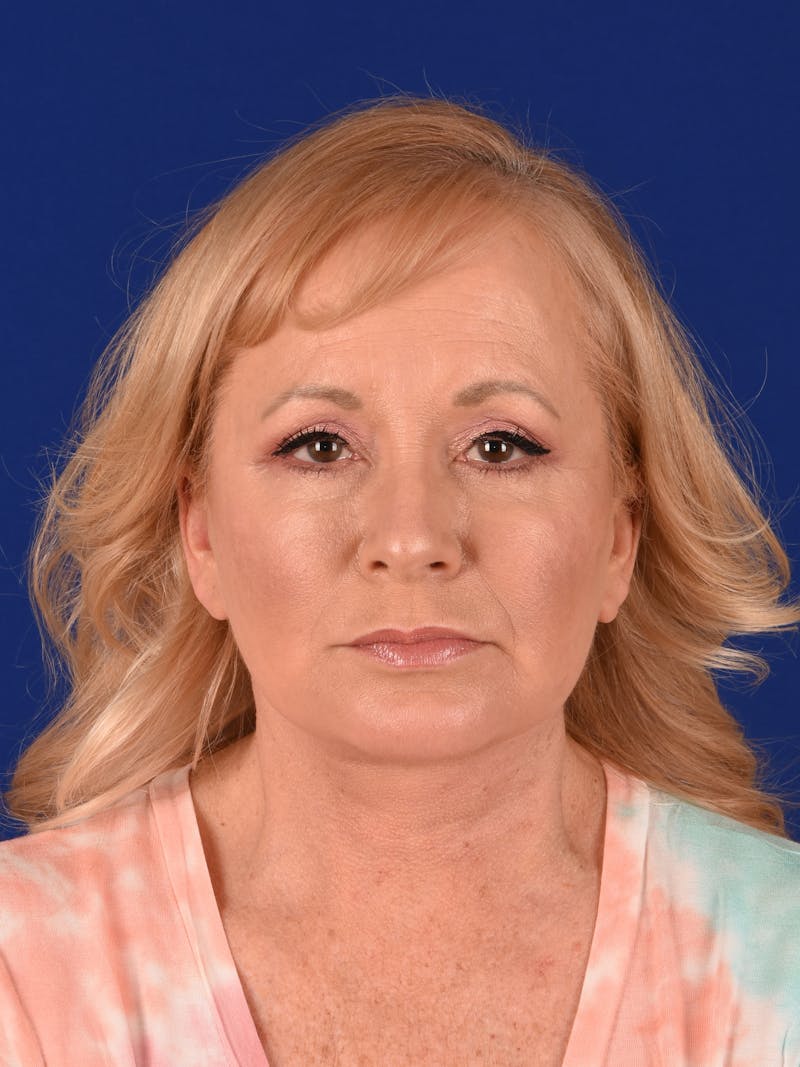 Facelift Before & After Gallery - Patient 10670025 - Image 2