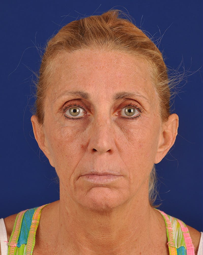 Facelift Before & After Gallery - Patient 10670028 - Image 1