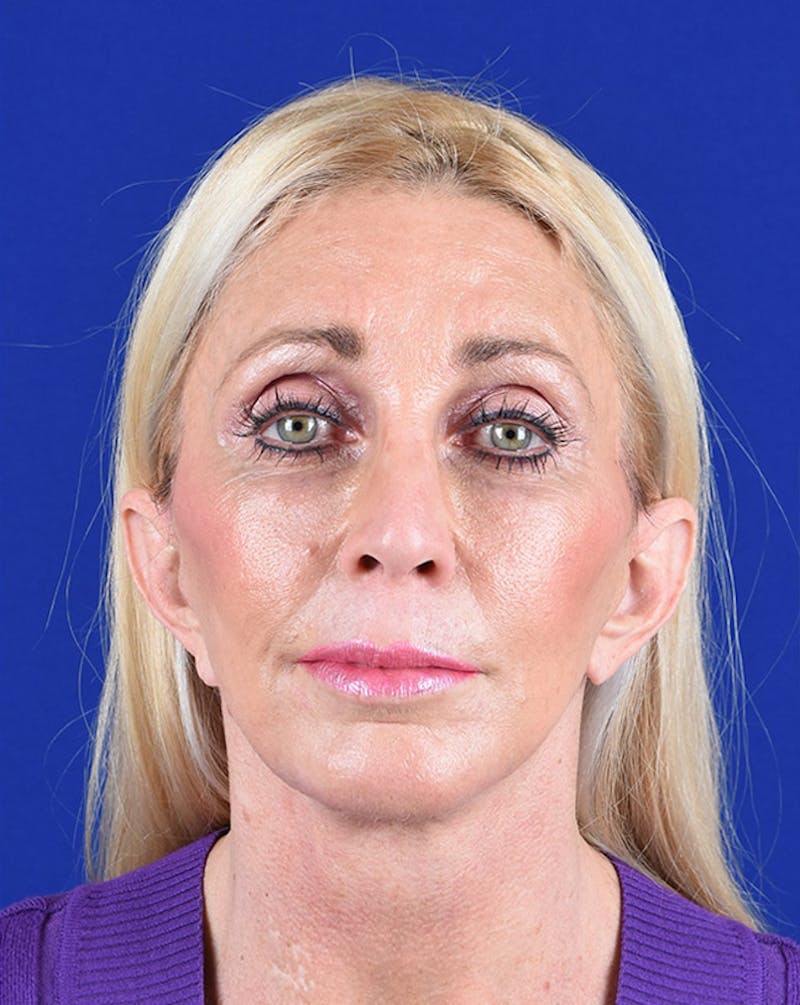 Facelift Before & After Gallery - Patient 10670028 - Image 2
