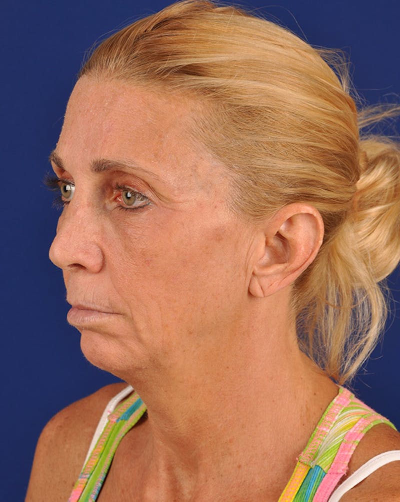 Facelift Before & After Gallery - Patient 10670028 - Image 3