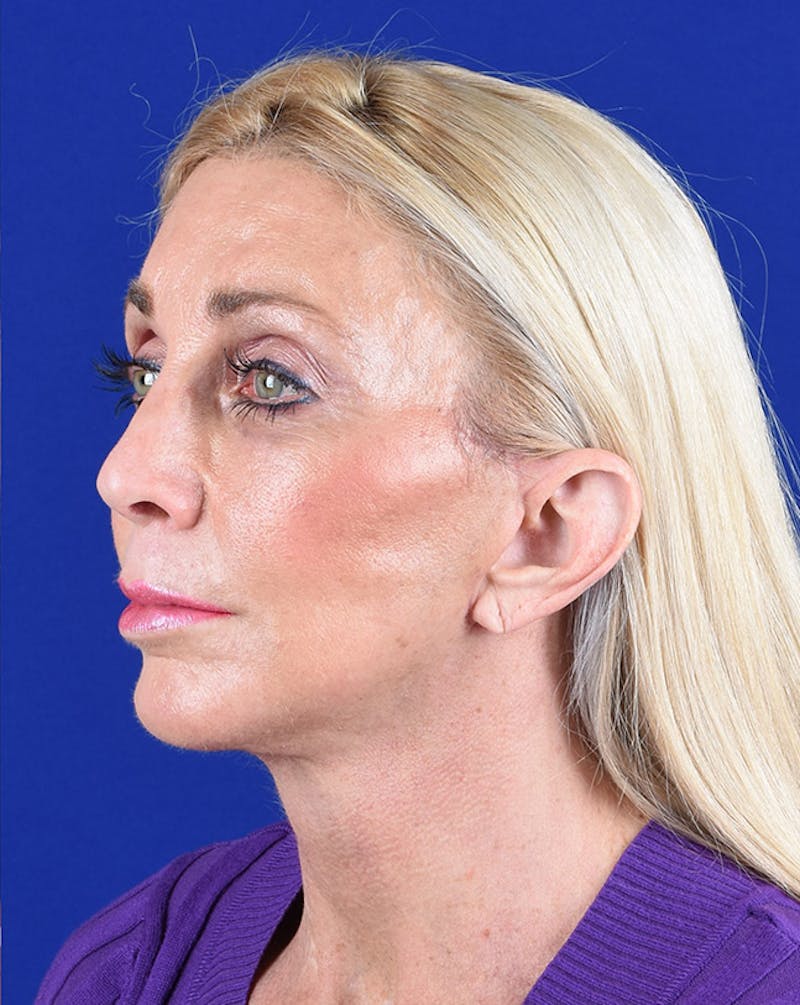 Facelift Before & After Gallery - Patient 10670028 - Image 4