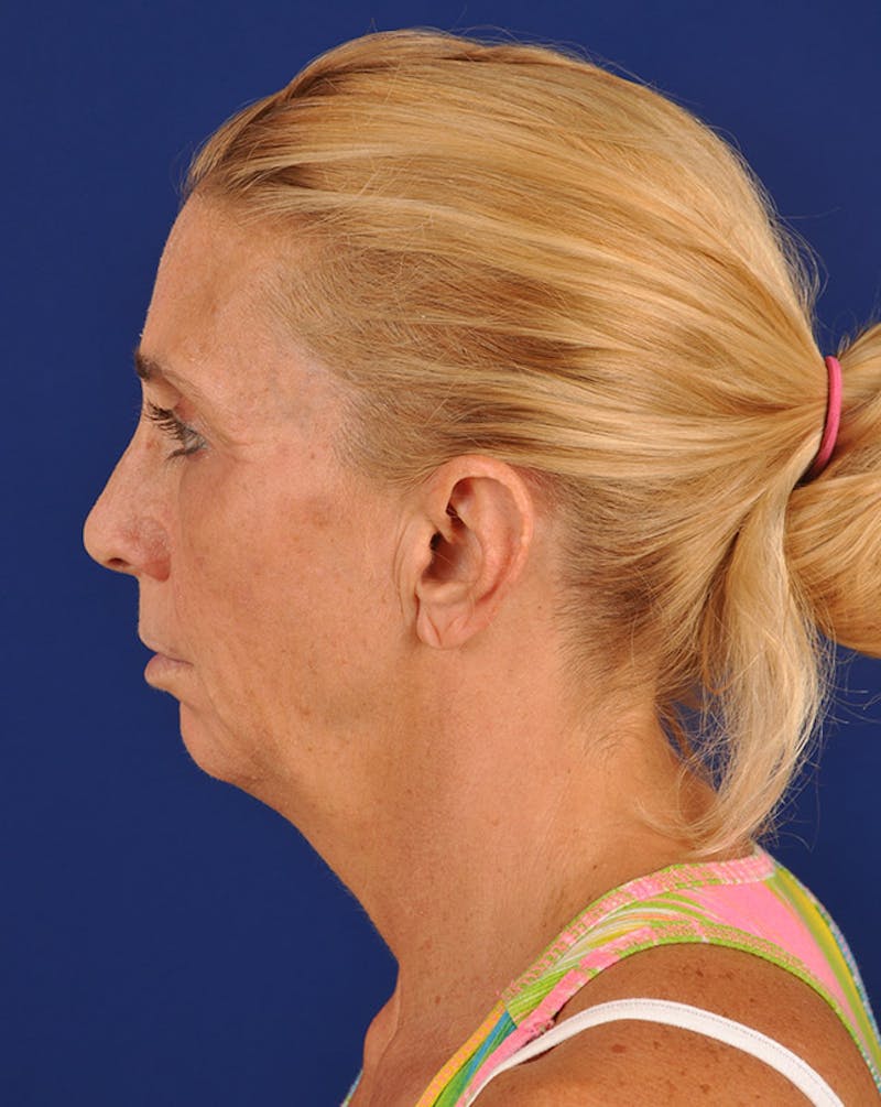 Facelift Before & After Gallery - Patient 10670028 - Image 5