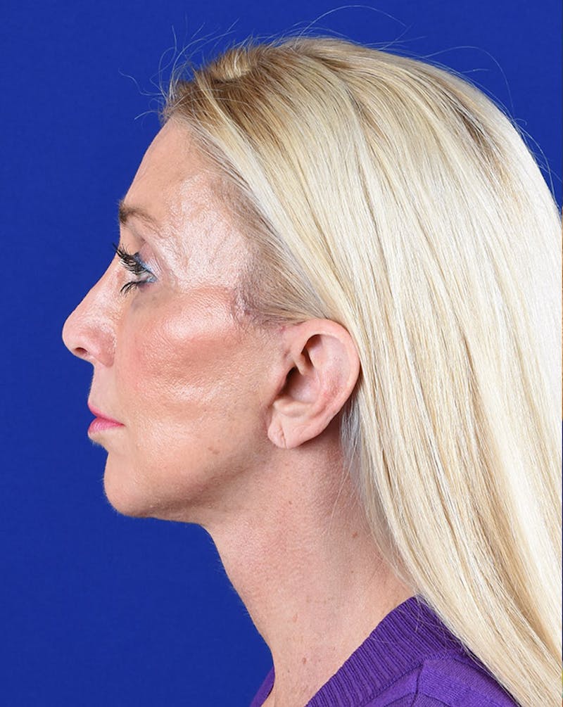 Facelift Before & After Gallery - Patient 10670028 - Image 6