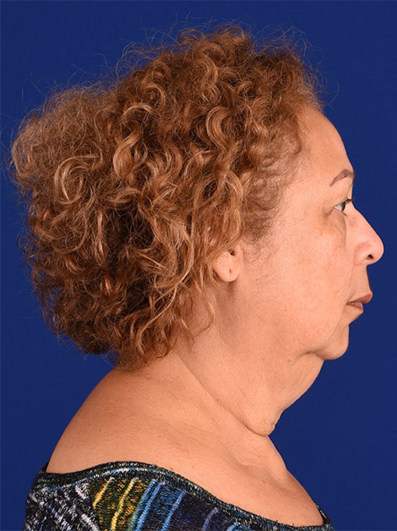 Facelift Before & After Gallery - Patient 10670032 - Image 5