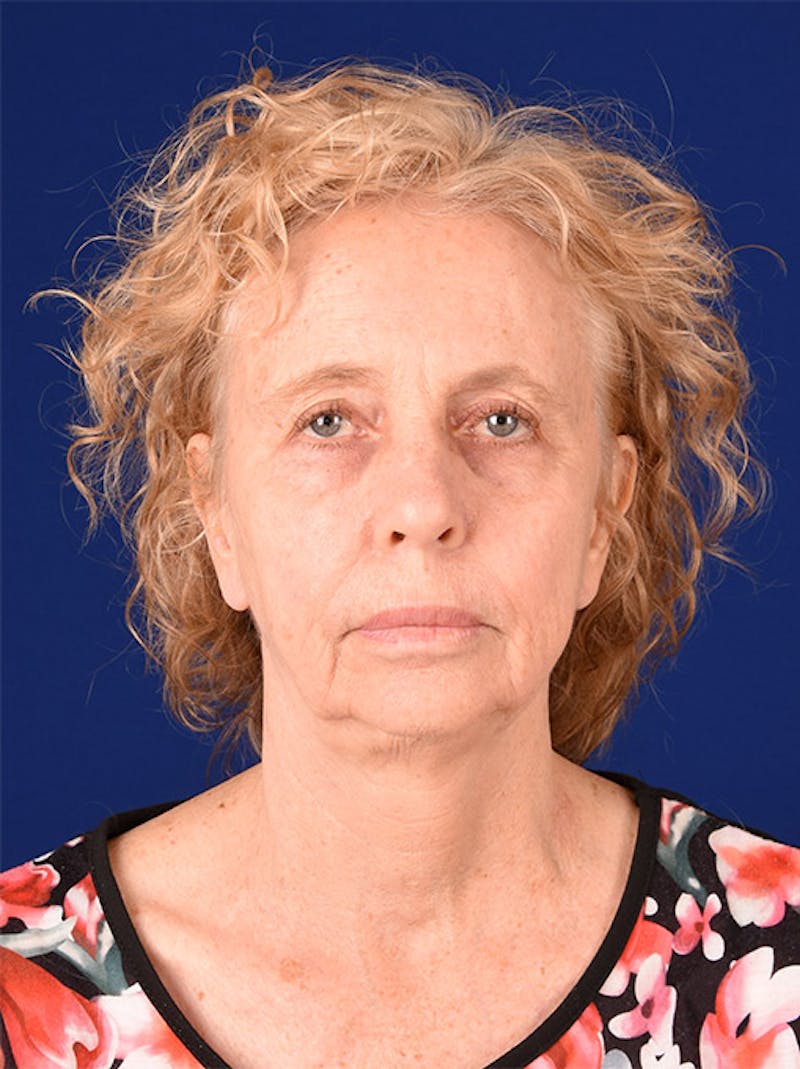 Facelift Before & After Gallery - Patient 10670038 - Image 1