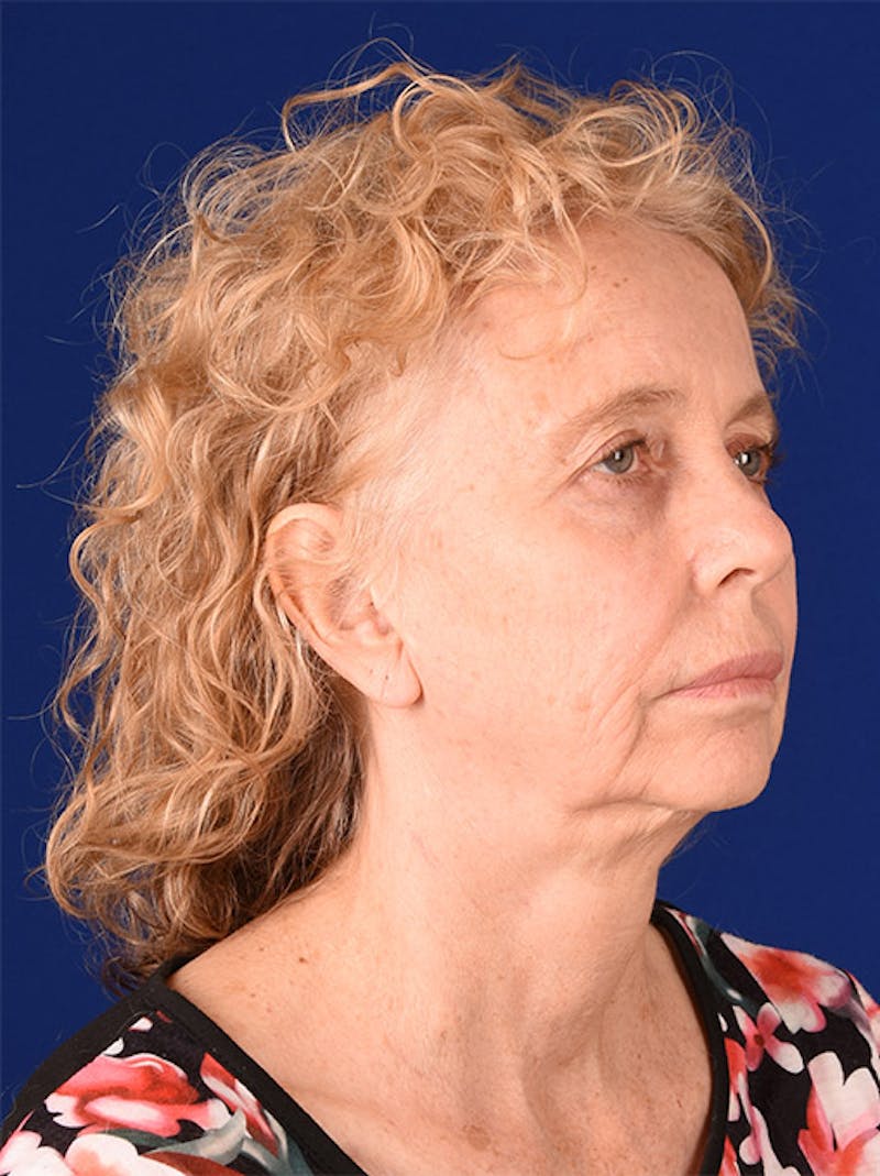 Facelift Before & After Gallery - Patient 10670038 - Image 3