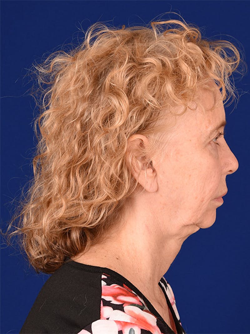 Facelift Before & After Gallery - Patient 10670038 - Image 5
