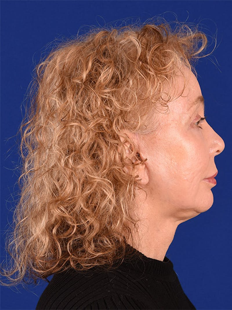Facelift Before & After Gallery - Patient 10670038 - Image 6