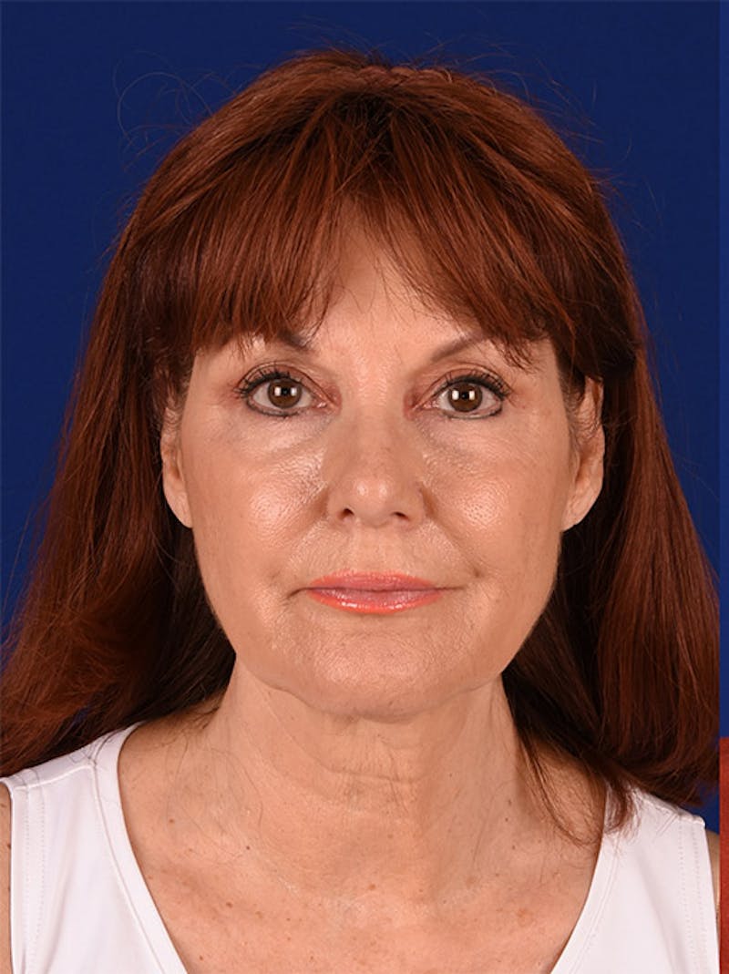Facelift Before & After Gallery - Patient 10670042 - Image 1