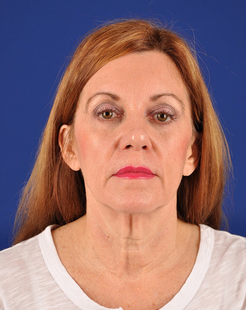 Facelift Before & After Gallery - Patient 10670046 - Image 1