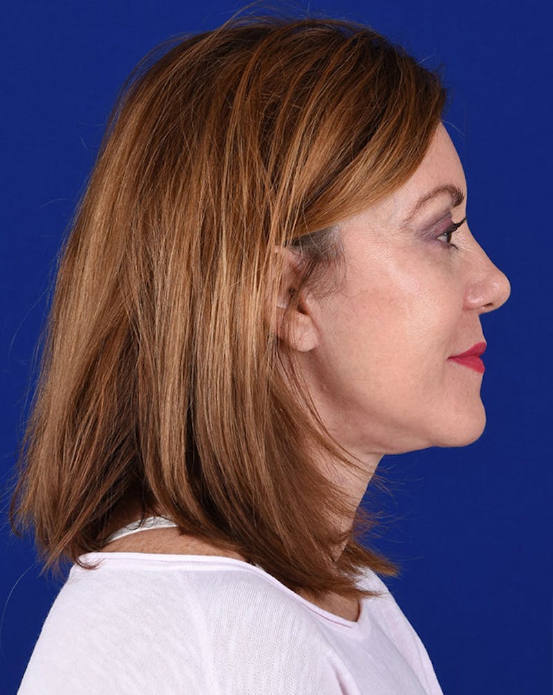 Facelift Before & After Gallery - Patient 10670046 - Image 6