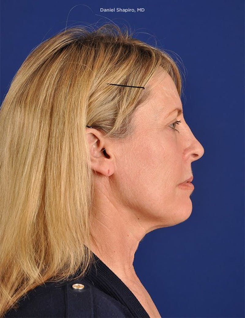 Facelift Before & After Gallery - Patient 10670052 - Image 5