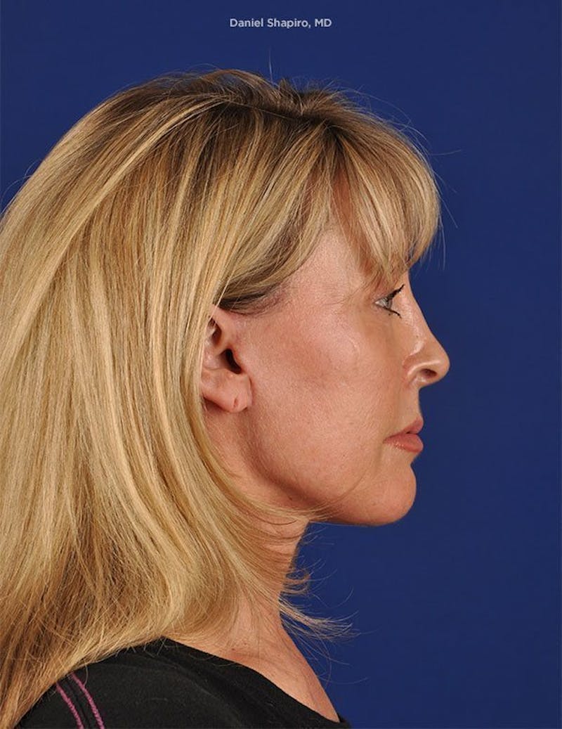Facelift Before & After Gallery - Patient 10670052 - Image 6
