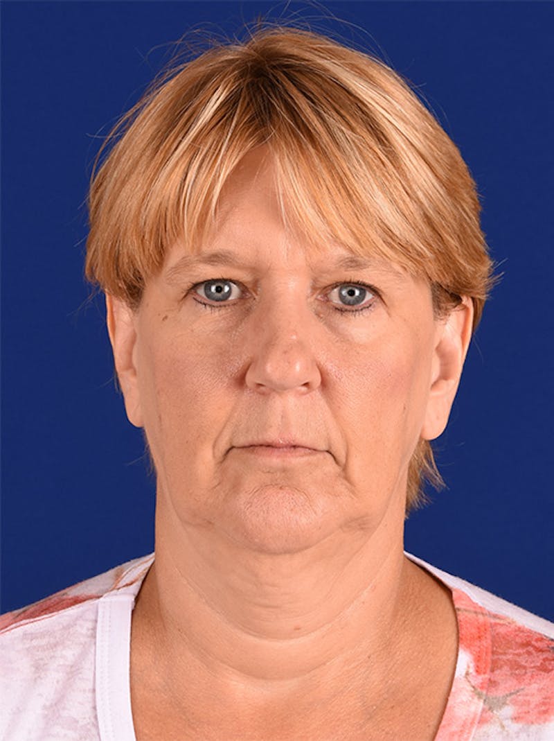 Facelift Before & After Gallery - Patient 10670057 - Image 1