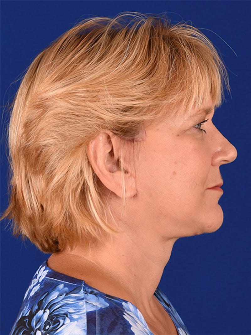 Facelift Before & After Gallery - Patient 10670057 - Image 6