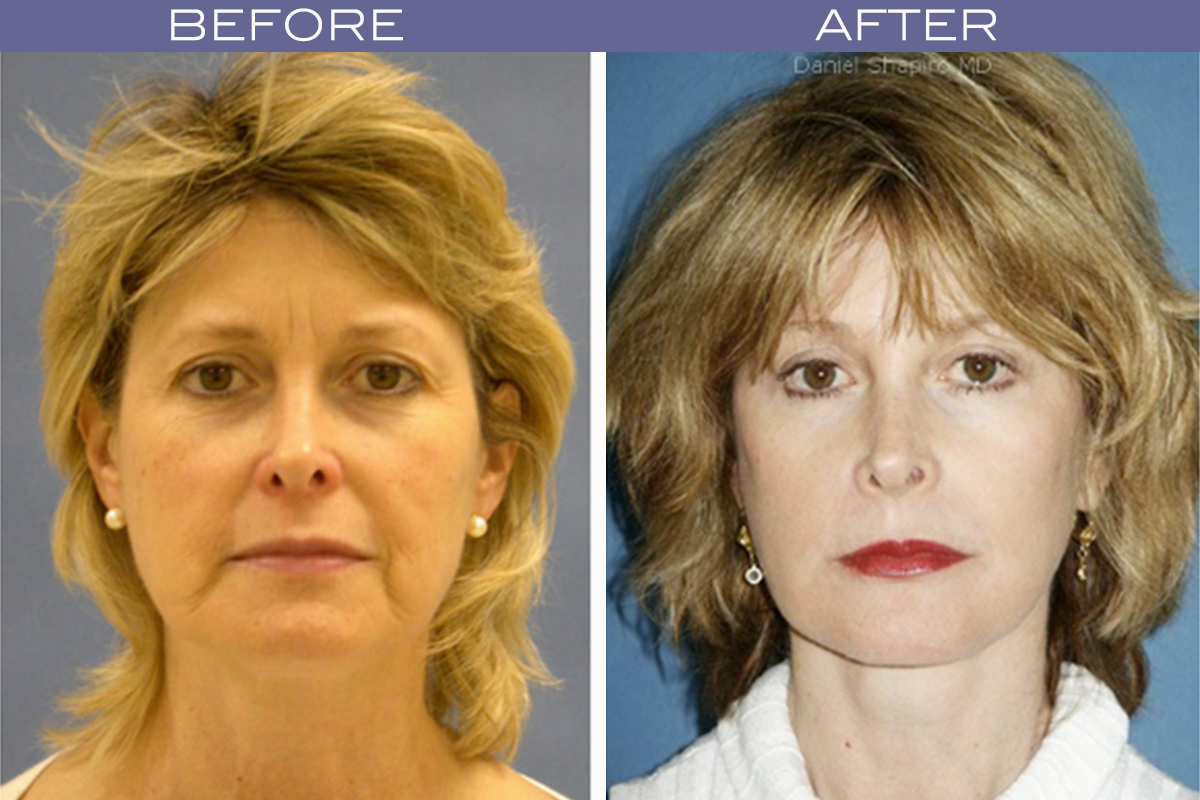 What Is The Right Age For A Facelift Dr Shapiro Aesthetic Plastic What Is The Right Age For A Facelift Dr Shapiro Aesthetic Plastic