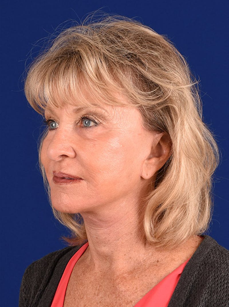 Facelift Before & After Gallery - Patient 10670085 - Image 4