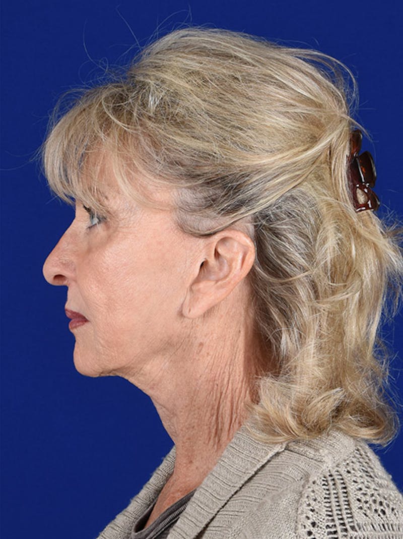 Facelift Before & After Gallery - Patient 10670085 - Image 5