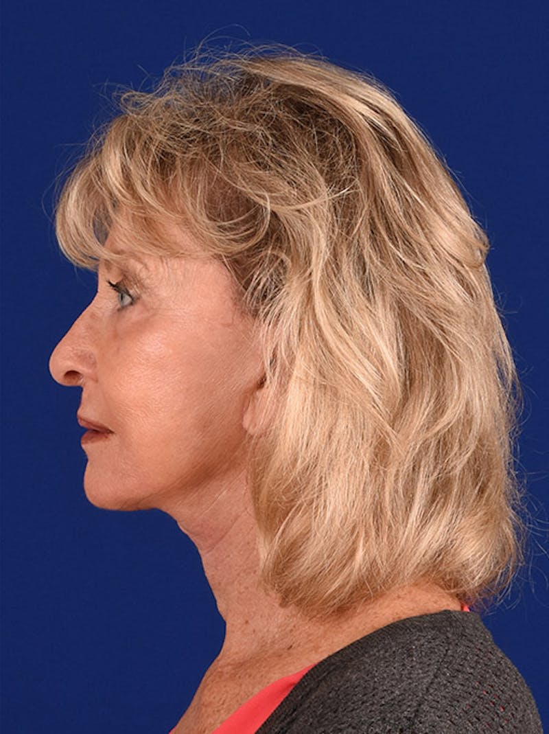 Facelift Before & After Gallery - Patient 10670085 - Image 6