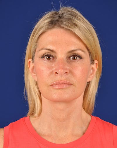 Facelift Before & After Gallery - Patient 10670092 - Image 2