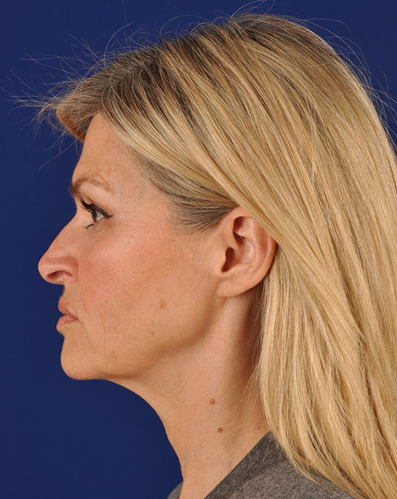 Facelift Before & After Gallery - Patient 10670092 - Image 5