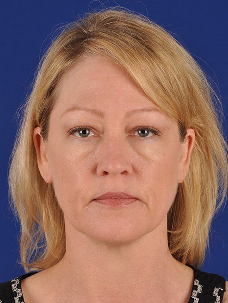 Facelift Before & After Gallery - Patient 10670095 - Image 1