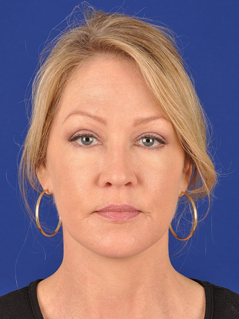 Facelift Before & After Gallery - Patient 10670095 - Image 2