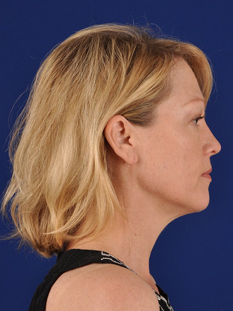 Facelift Before & After Gallery - Patient 10670095 - Image 5