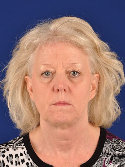 Facelift Before & After Gallery - Patient 10670100 - Image 1