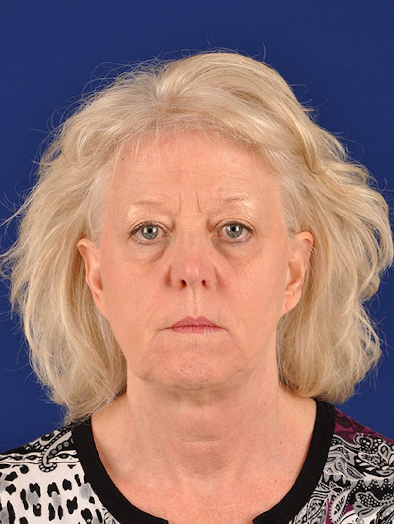 Facelift Before & After Gallery - Patient 10670100 - Image 1