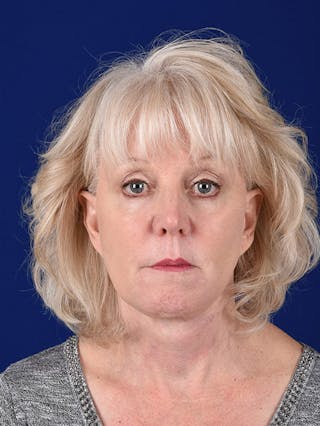 Facelift Before & After Gallery - Patient 10670100 - Image 2