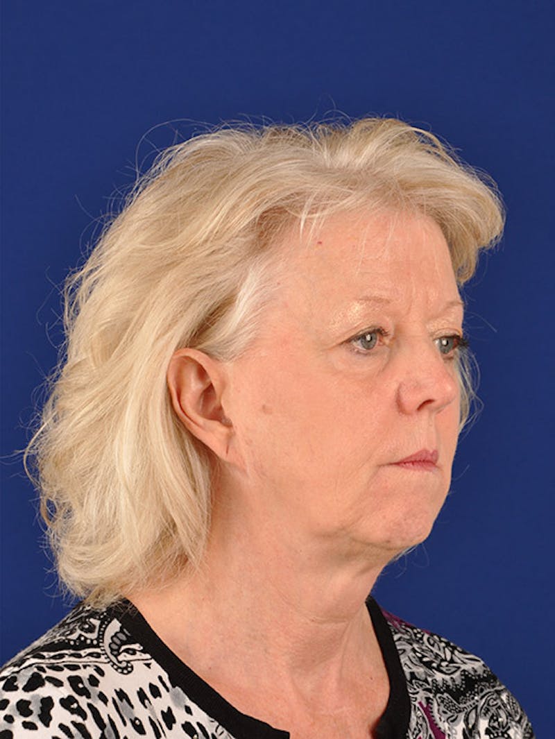 Facelift Before & After Gallery - Patient 10670100 - Image 3