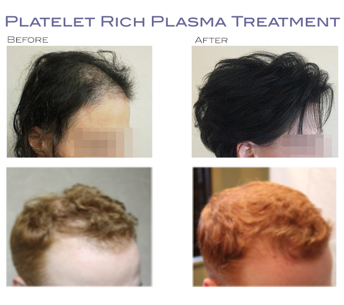PRP Treatments for Hair Loss and Skin Rejuvenation - Dr. Shapiro Aesthetic  Plastic Surgery & Skin Klinic