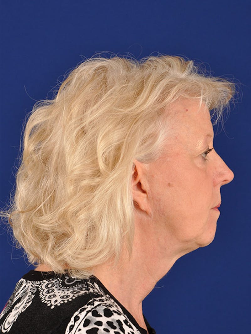 Facelift Before & After Gallery - Patient 10670100 - Image 5