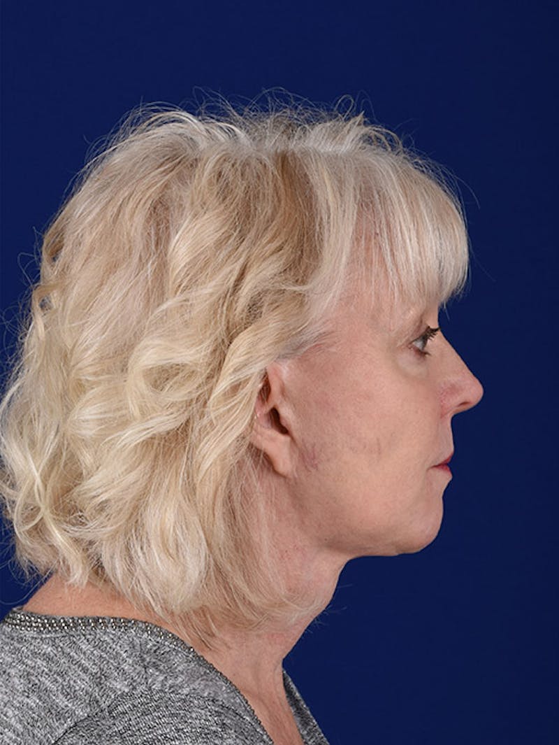 Facelift Before & After Gallery - Patient 10670100 - Image 6