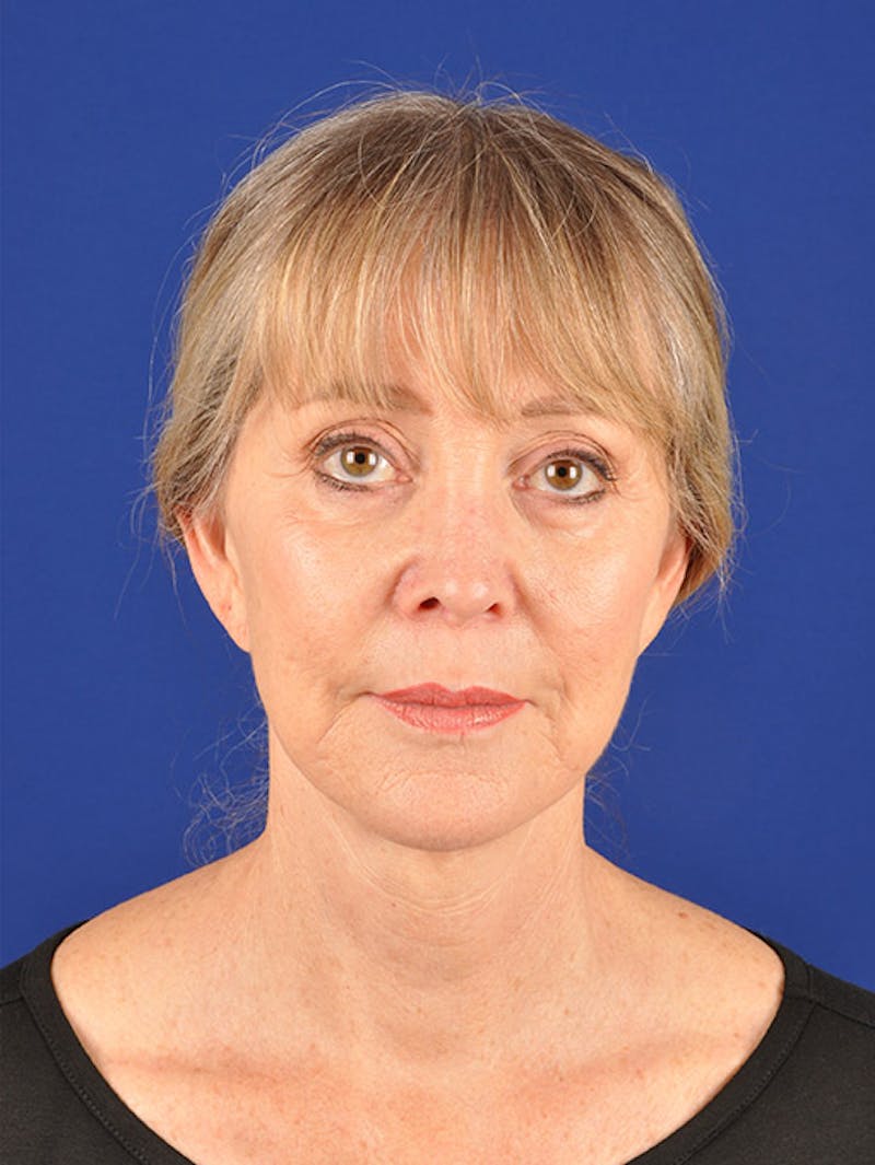 Facelift Before & After Gallery - Patient 10670106 - Image 1