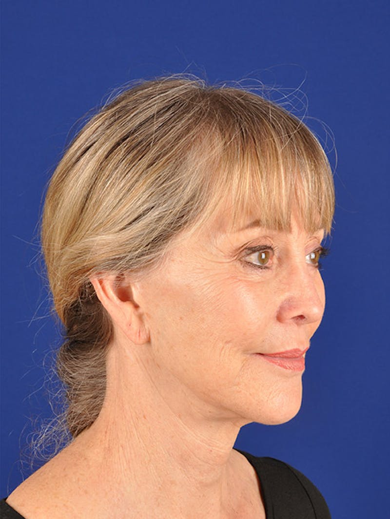 Facelift Before & After Gallery - Patient 10670106 - Image 3