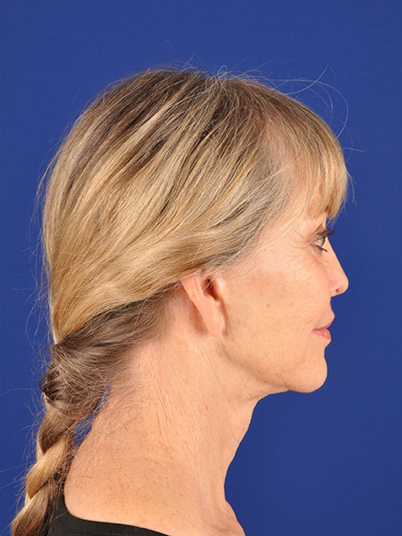 Facelift Before & After Gallery - Patient 10670106 - Image 5