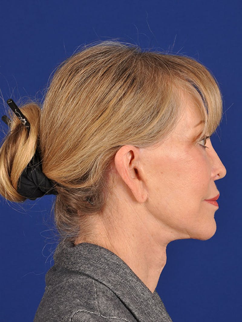 Facelift Before & After Gallery - Patient 10670106 - Image 6