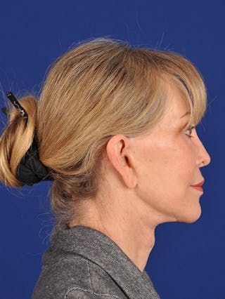 Facelift Before & After Gallery - Patient 10670106 - Image 6