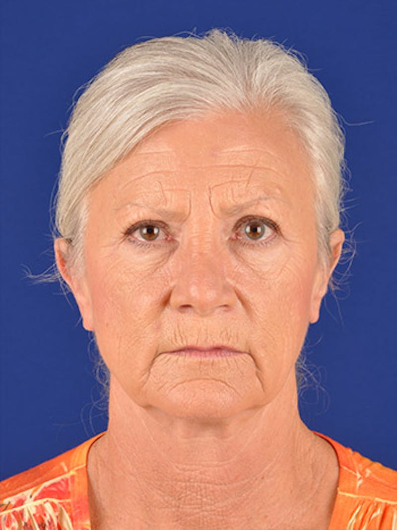 Facelift Before & After Gallery - Patient 10670349 - Image 1