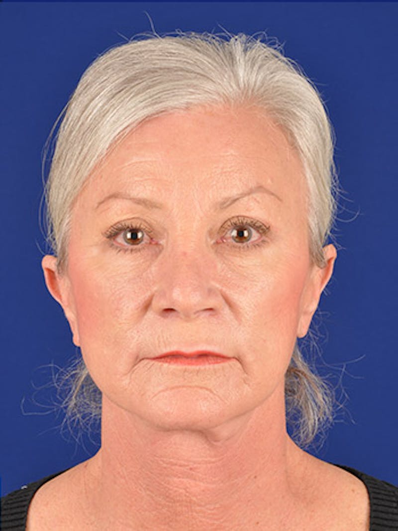 Facelift Before & After Gallery - Patient 10670349 - Image 2