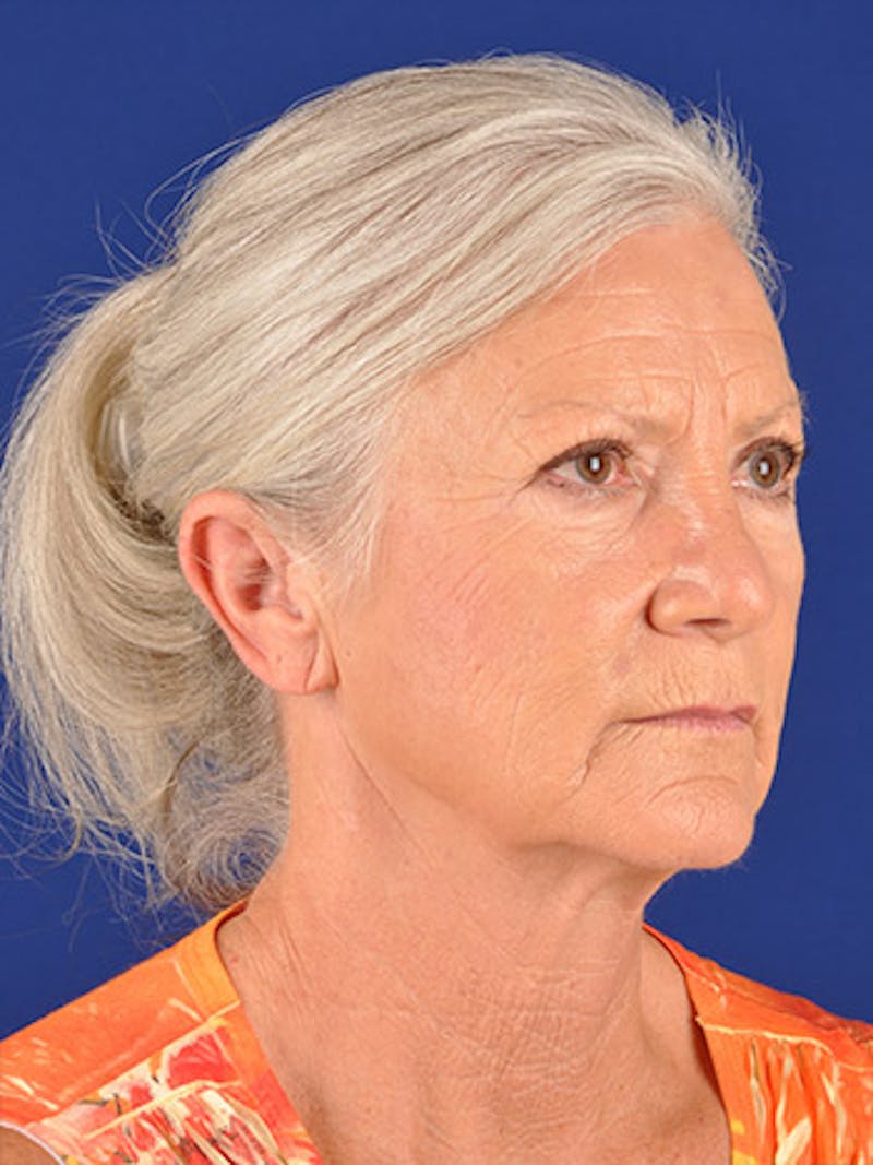 Facelift Before & After Gallery - Patient 10670349 - Image 3