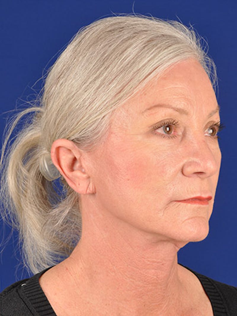 Facelift Before & After Gallery - Patient 10670349 - Image 4