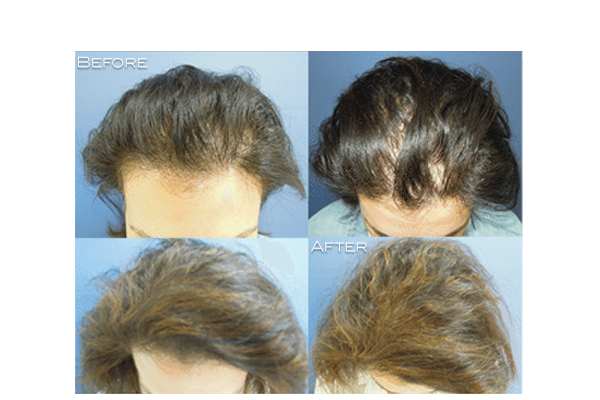Evidence For Platelet Rich Plasma (PRP) Treatment For Hair Loss