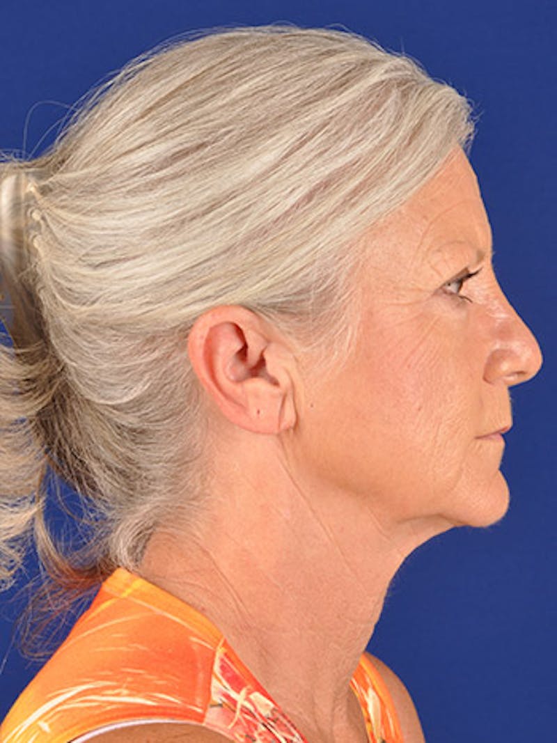 Facelift Before & After Gallery - Patient 10670349 - Image 5